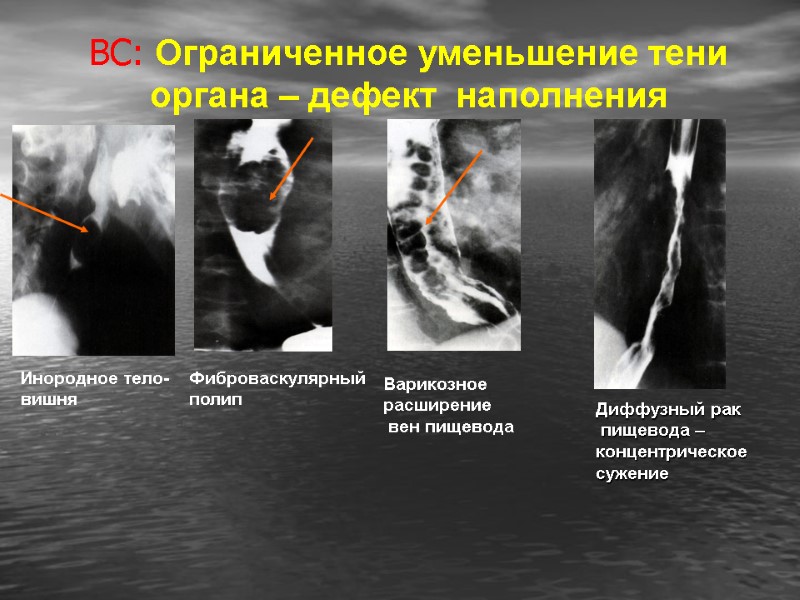 ВС: Ограниченное уменьшение тени органа – дефект  наполнения Инородное тело- вишня Фиброваскулярный полип